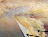 example fascia tear